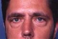 augenlider4_vor