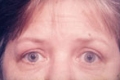 augenlider5_nach
