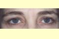 botox1_nach