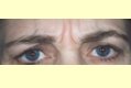 botox1_vor