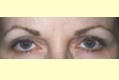 botox2_nach
