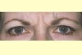 botox2_vor