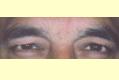 botox3_nach