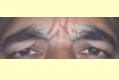 botox3_vor