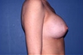 brust12_nach
