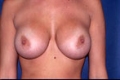 brust14_nach