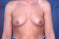 brust2_vor