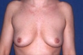brust3_vor