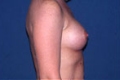 brust5_nach