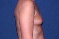 brust5_vor