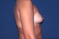brust8_vor