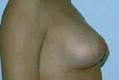 brustred3_nach