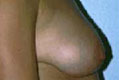 brustred3_vor