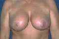 brustred4_nach