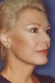 gesicht4_nach