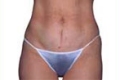 lipo1_nach