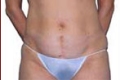 lipo1_vor