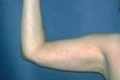 lipo4_nach