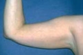 lipo4_vor