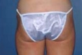 lipo5_nach