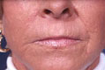 peeling1_nach