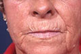 peeling1_vor