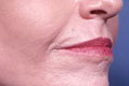 peeling2_nach