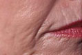 peeling2_vor