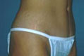 tummy2_nach