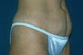 tummy2_vor