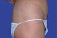 tummy4_nach