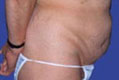 tummy4_vor